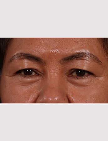 Before Image: Upper Blepharoplasty - front