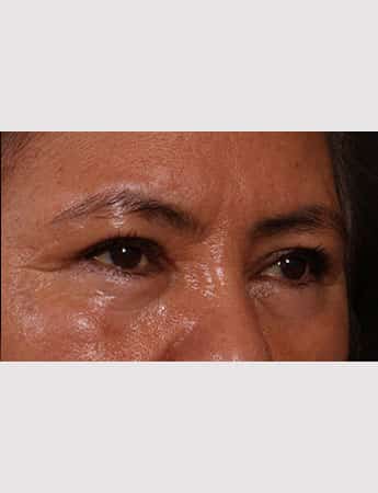 After Image: Upper Blepharoplasty - right-front-oblique