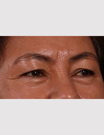 Before Image: Upper Blepharoplasty - right-front-oblique