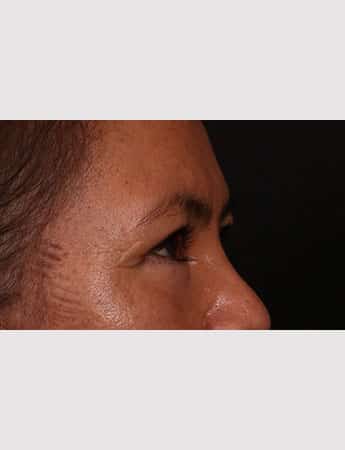 After Image: Upper Blepharoplasty - right-side