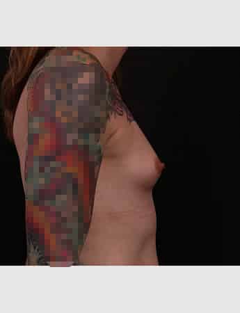 Before Image: Transgender Breast Augmentation - right-side