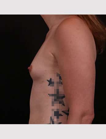 Before Image: Transgender Breast Augmentation - left-side
