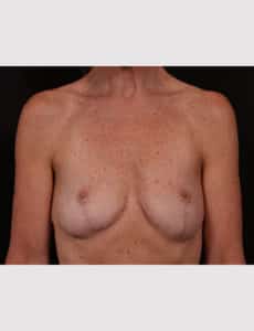 After Image: Implant Removal
