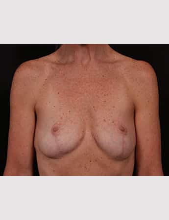 After Image: Implant Removal - front