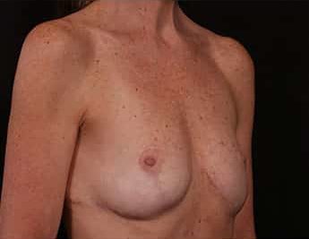 After Image: Implant Removal - right-front-oblique
