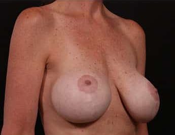 Before Image: Implant Removal - right-front-oblique