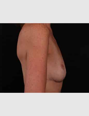 After Image: Implant Removal - right-side
