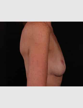 After Image: Secondary Breast Surgery - right-side