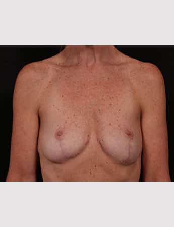 After Image: Breast Reduction - front