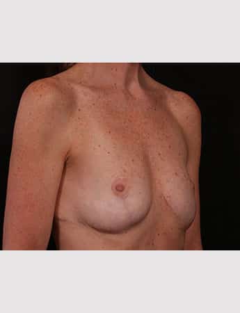 After Image: Breast Reduction - right-front-oblique