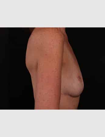 After Image: Breast Reduction - right-side