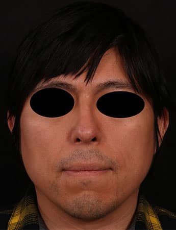 After Image: Rhinoplasty - front