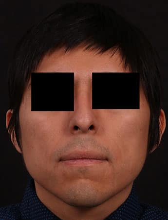 Before Image: Rhinoplasty - front