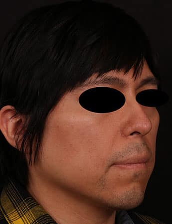 After Image: Rhinoplasty - right-front-oblique