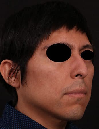 Before Image: Rhinoplasty - right-front-oblique