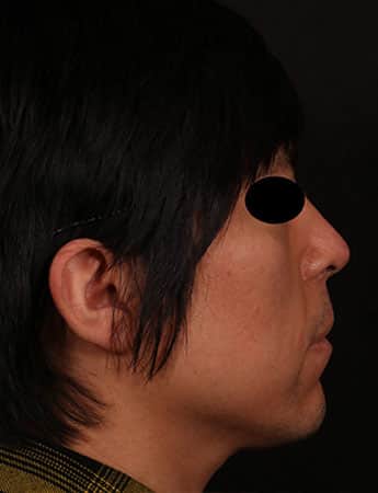 After Image: Rhinoplasty - right-side