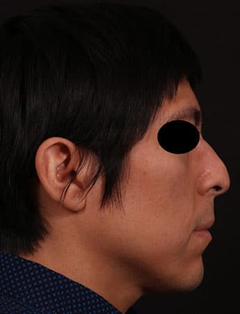 Before Image: Rhinoplasty - right-side