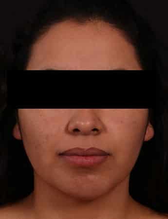 After Image: Chin Implant - front
