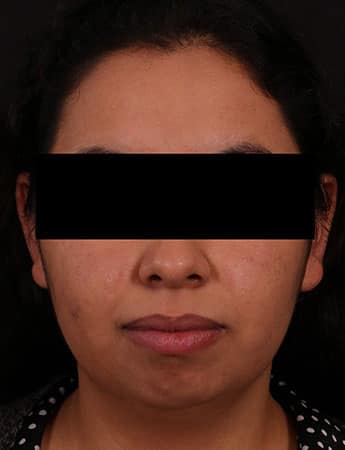 Before Image: Chin Implant - front