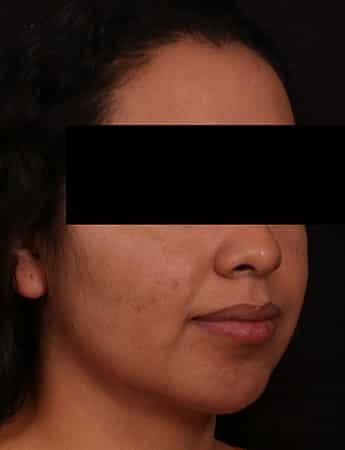 After Image: Chin Implant - right-front-oblique