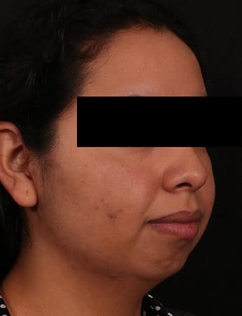 Before Image: Chin Implant - right-front-oblique