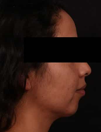 After Image: Chin Implant - right-side