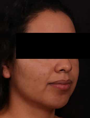 After Image: Neck Liposuction - right-front-oblique