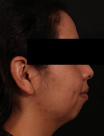 Before Image: Neck Liposuction - right-side
