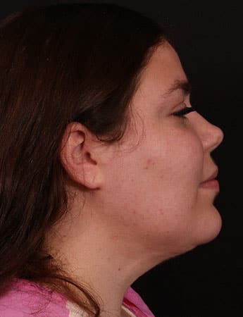 After Image: Neck Liposuction - right-side