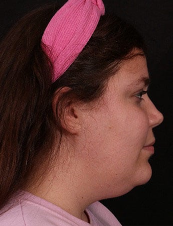 Before Image: Neck Liposuction - right-side