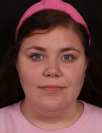 Before Image: Neck Liposuction - front