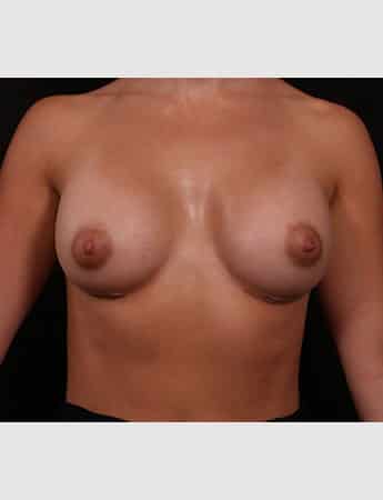 After Image: Breast Augmentation - front