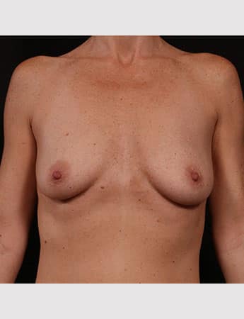 Before Image: Breast Augmentation - front