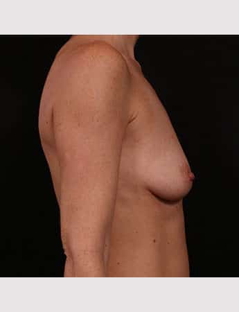 Before Image: Breast Augmentation - right-side