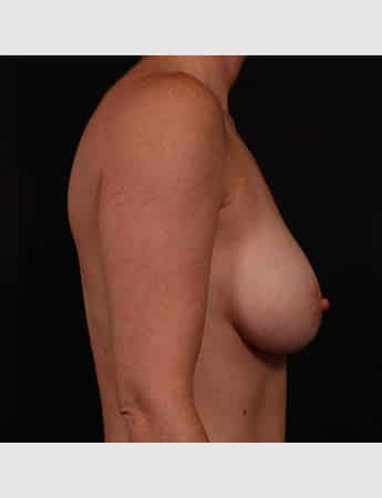 After Image: Breast Augmentation - right-side