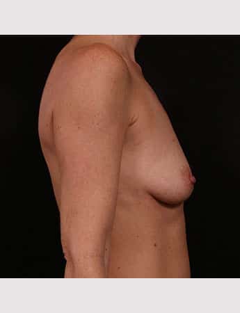 Before Image: Breast Augmentation - right-side