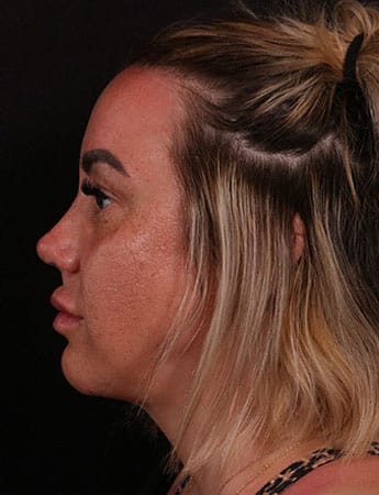 After Image: Buccal Fat Removal - left-side