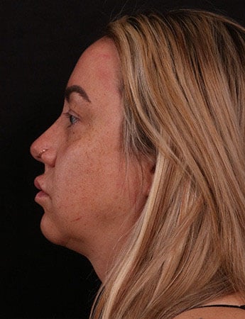 Before Image: Buccal Fat Removal - left-side