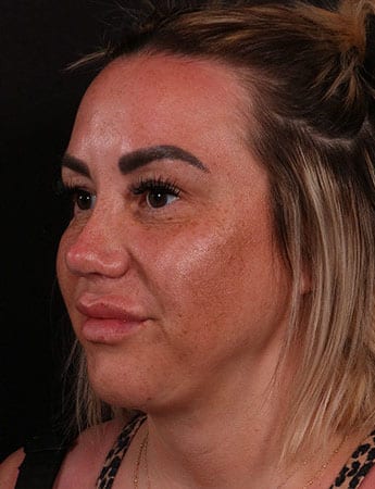 After Image: Buccal Fat Removal -