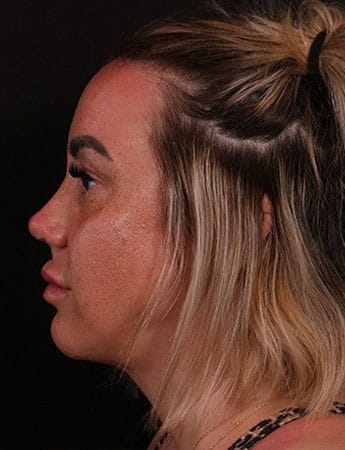After Image: Neck Liposuction - left-side
