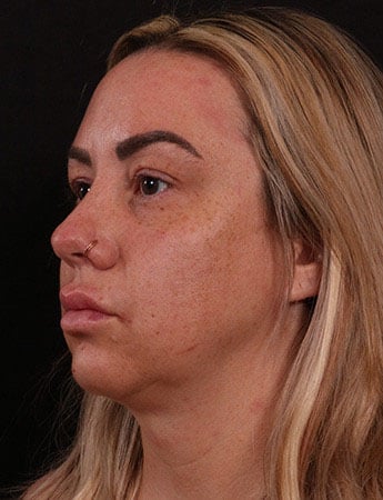 Before Image: Neck Liposuction - left-front-oblique
