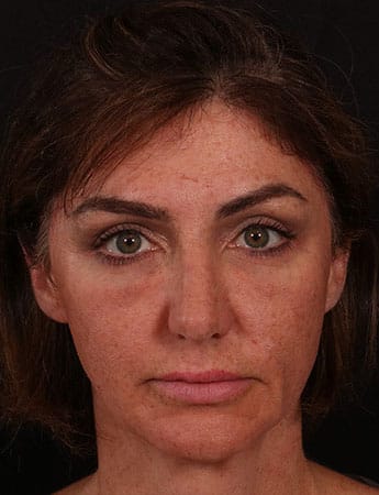 After Image: Facial Fillers - front