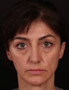 Before Image: Facial Fillers