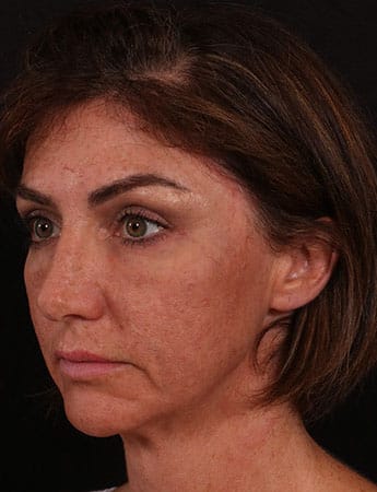 After Image: Facial Fillers - left-front-oblique