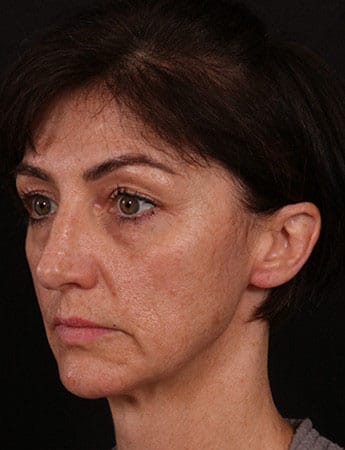 Before Image: Facial Fillers - left-front-oblique