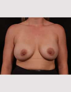 Before Image: Breast Lift With Augmentation