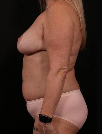 Before Image: Mommy Makeover - left-side