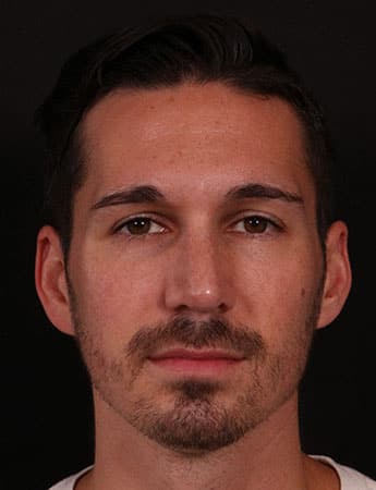 After Image: Rhinoplasty - front