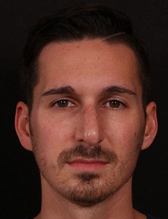 Before Image: Rhinoplasty - front