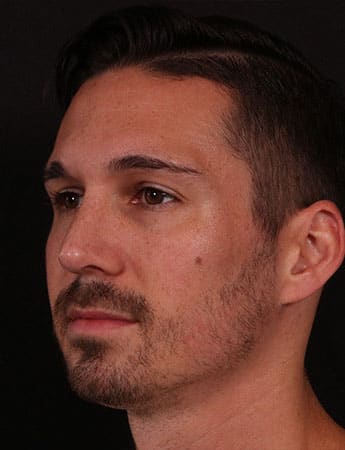 After Image: Rhinoplasty - left-front-oblique